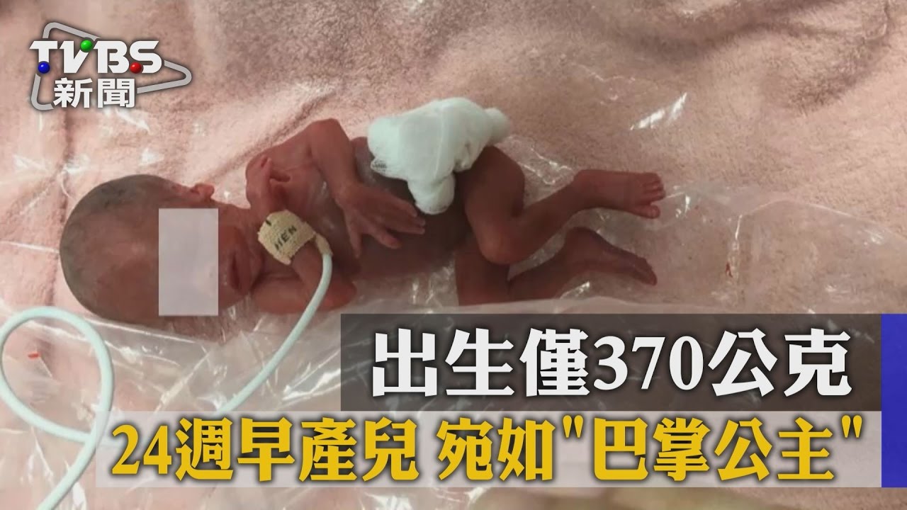 24週早產兒!出生僅370公克 宛如「巴掌公主」