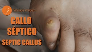 Callo séptico - Septic callus - Calo séptico [Podología Integral]