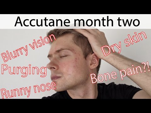 2 months on ACCUTANE for mild, stubborn acne | PURGING & SIDE EFFECTS