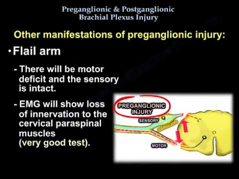 Brachial Plexus Pre and Postganglionic Injury