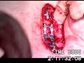 Modified Ravitch Procedure for Pectus Ex