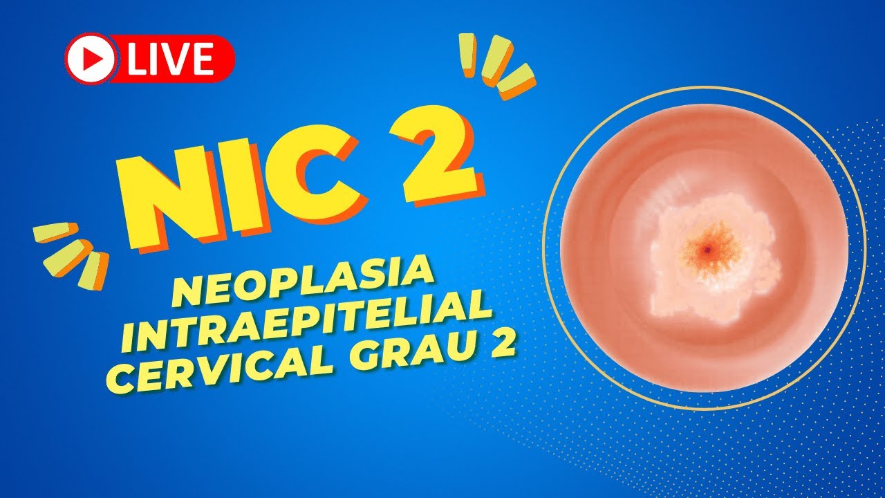 Nic 2: neoplasia intraepitelial cervical grau 2 = neoplasia do Colo do útero