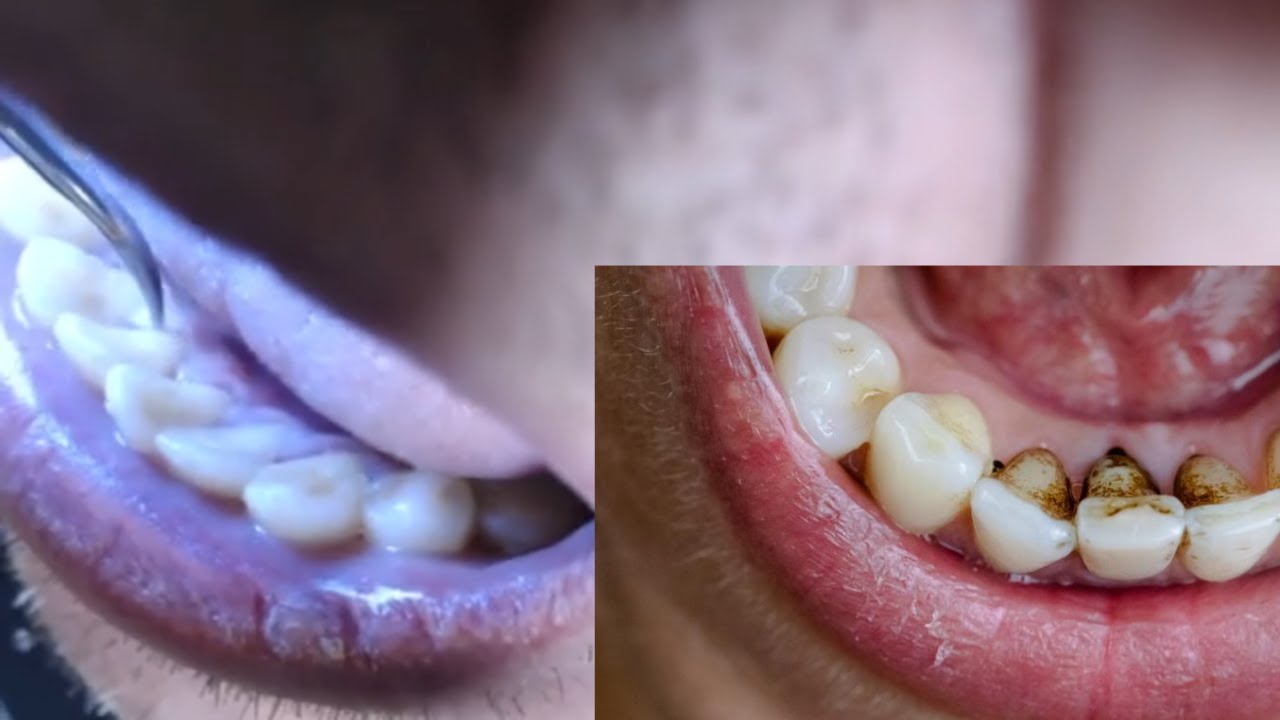 Pulizia dei denti con ultrasuoni come dal dentista fai da te