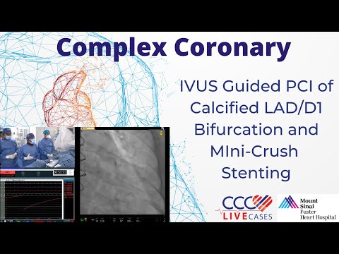 IVUS Guided PCI of Calcified LAD/D1 Bifurcation and Mini-Crush Stenting