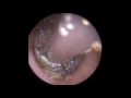 'Vibrating' Eardrum during Attempted Removal of Ear Wax - Mr Neel Raithatha (The Hear Clinic)