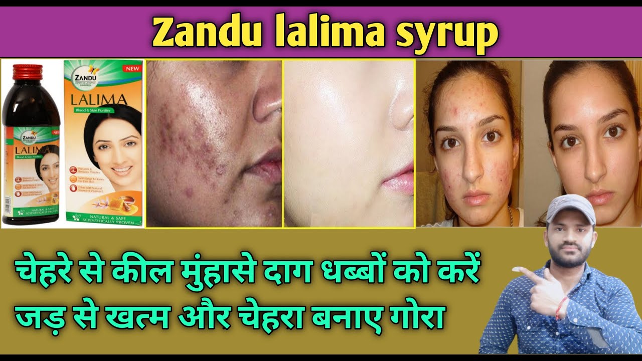 Zandu lalima syrup use dose benefits and side effects full review in hindi