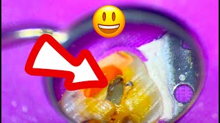 Shaping a Super Constricted MB2 {No Glidepath}