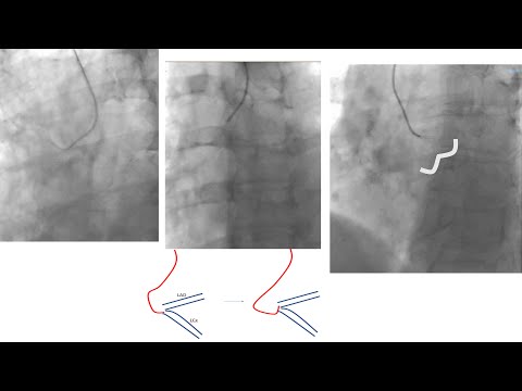 Review of radial catheter techniques: case illustrations + troubleshooting (what is the next step?)