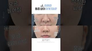 리쥬란 아프지 않게 시술 받는 법❤️‍🔥