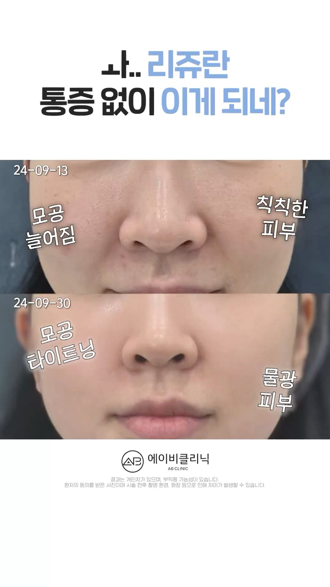 리쥬란 아프지 않게 시술 받는 법❤️‍🔥