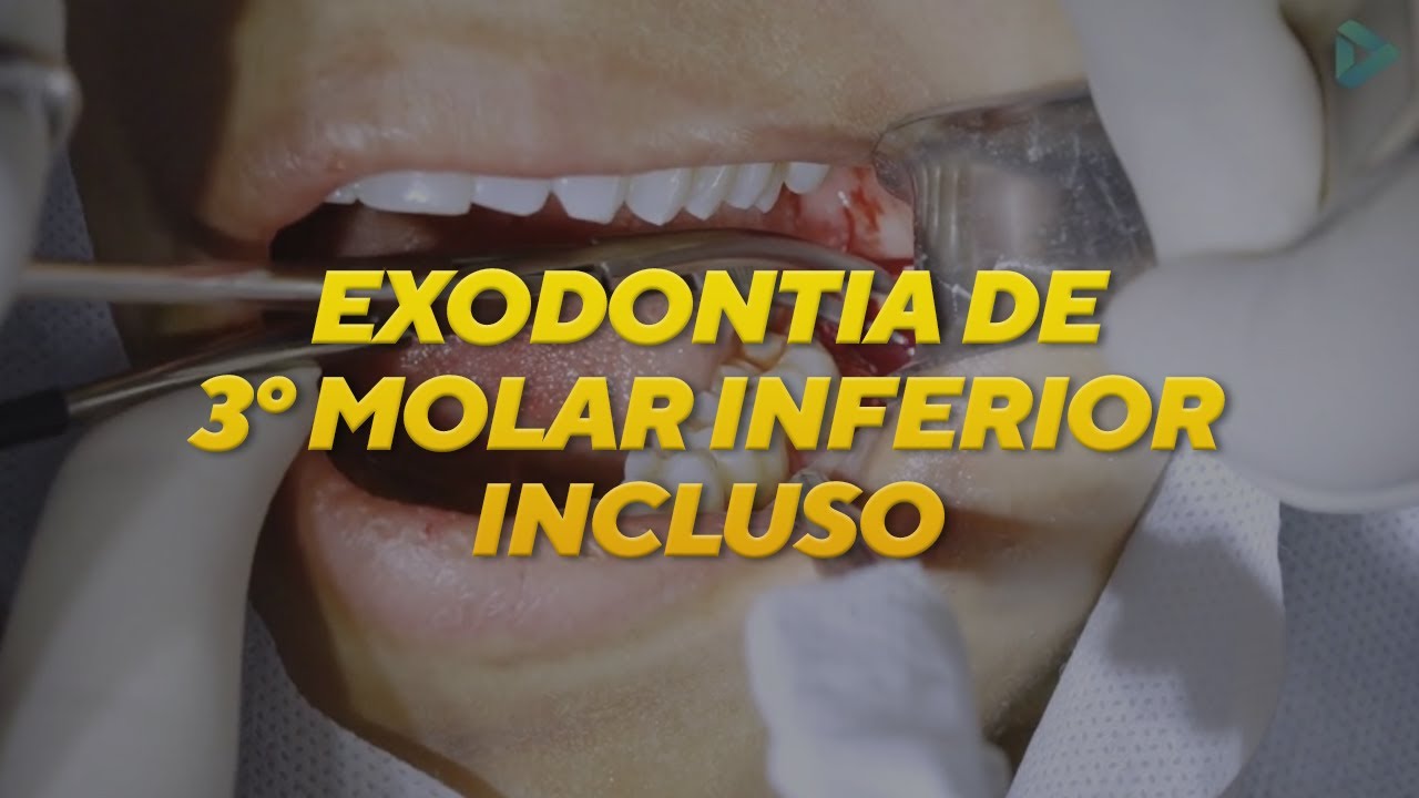 EXODONTIA DE TERCEIRO MOLAR INCLUSO | CIRURGIA