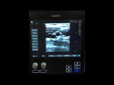 Ultrasound-Guided Axillary Brachial Plexus Block