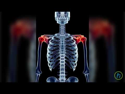 Tratamentul radiologic al artrozei