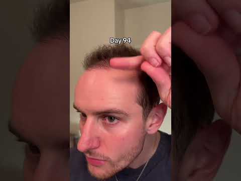 3-Month Hair Transplant Progress, Zeph Sanders Shows His | 4100 Grafts Later