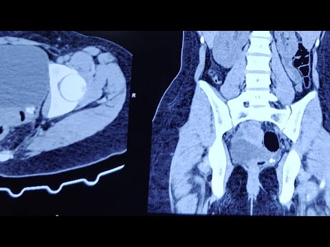 Calcification post endoscopic treatment for VUR masquerading sd VUJ calculus @Pediatric-Urologist
