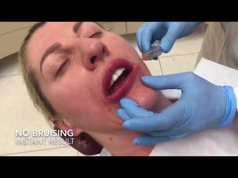 Demonstration of lip filler treatment using a cannula