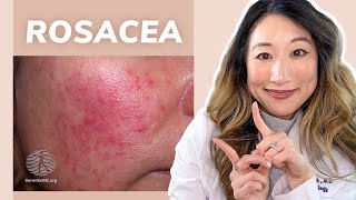 Dermatologist Guide to ROSACEA - Treatments & Skincare Products