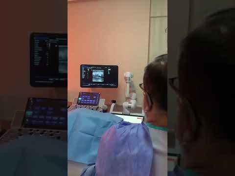 Lazerle VARİS TEDAVİSİ İşlem Video-Лазерное лечение варикозного расширения вен, видео в прямом эфире