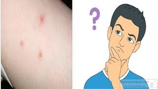 how to identify bed bug bites 100% MUST WATCH ATLEAST ONCE!!!!