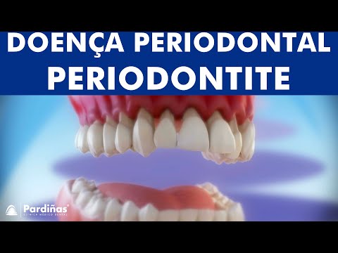 Doença periodontal o periodontite ©
