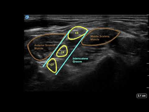 Ultrasound guided interscalene and supraclavicular brachial plexus block