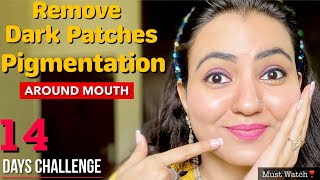 In 14 Days 💕 Remove Dark Patches, Pigmentation, Dark Spots Around Mouth Naturally | 100% Results