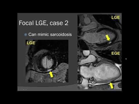 State of the Art Cardiac MRI for Myocarditis February 15  2019