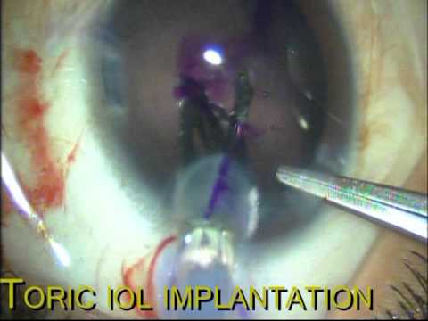 Toric IOL Implantation in a Case of Bilateral Pediatric Cataract