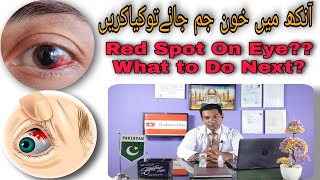Red spot in eye | Red dot eyes | subconjunctival hemorrhage treatment | aankh mein khoon aana
