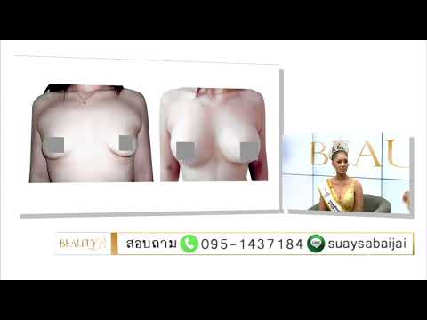 หน้าอกพลาสติกสีขาวอิกอร์ ครีมกวมบนหน้าอก