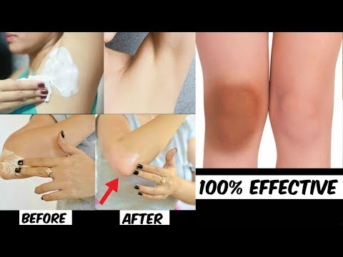 How To Lighten Dark Knees, Dark Elbows, Dark Underarms - Lighten Your Dark Body Parts Naturally Video
