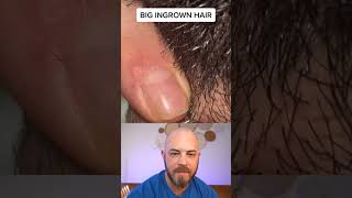 Derm reacts to enflamed ingrown hair removal on head! #dermreacts #doctorreacts #ingrownhair