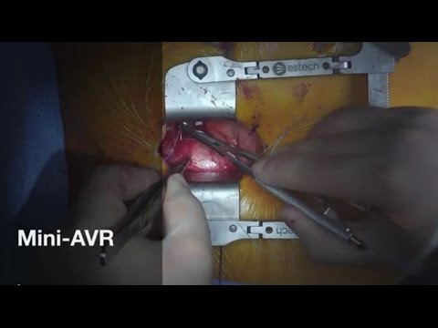 Minimally Invasive Aortic Valve Replacement