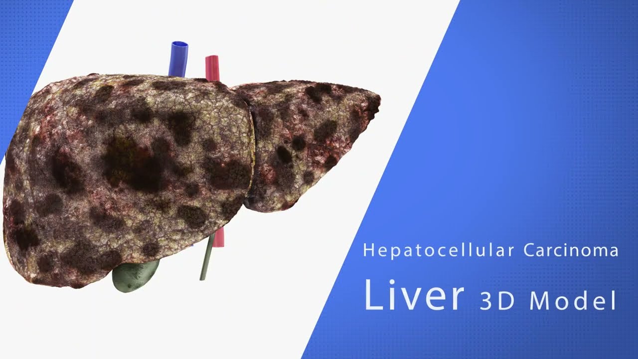Hepatocellular Carcinoma Liver 3D Model