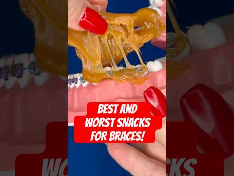 BEST & WORST SNACKS FOR BRACES 😬 🦷 #braces #snacks #asmr