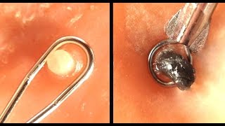 How To Use A Comedone Extractor Tool