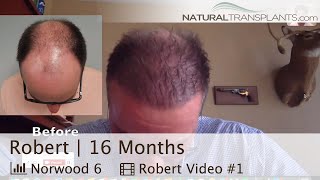 Hair Transplant Before and After | Hair Transplant Before and After Videos (Robert)