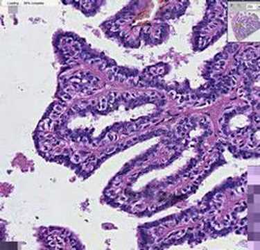 Amely egy papillomatosis