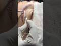 Eyebrow Transplant With Sapphire FUE Method In India