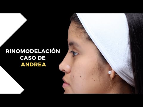 Caso de ANDREA : Rinomodelación