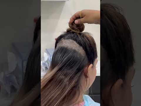 Female hair transplant | Dadu Medical Centre | Dr. Nandni Daddu