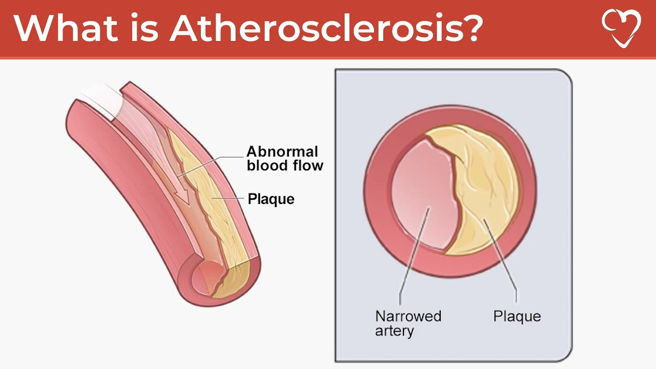 What is Heart Disease (Atherosclerosis)?