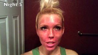 Fractional CO2 Laser Review