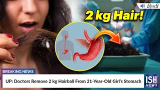 UP: Doctors Remove 2 kg Hairball From 21-Year-Old Girl’s Stomach