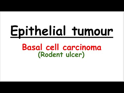 Basal cell carcinoma (rodent ulcer)-English