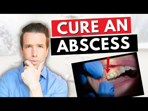Dentist Explains a Tooth Abscess | How to Cure an Abscess Tooth