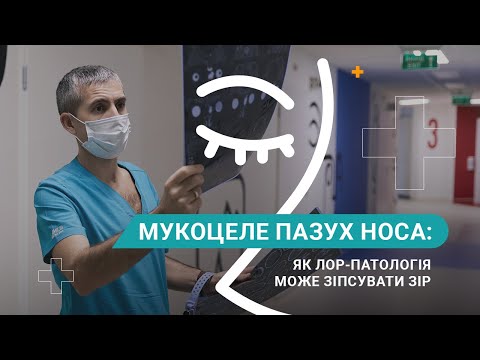 Мукоцеле пазух носа - відео