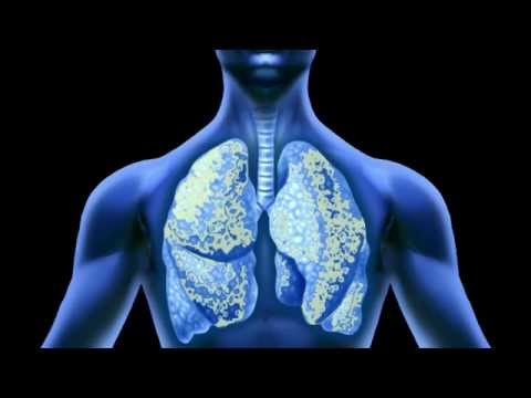 Effects of Asbestos on the Lungs