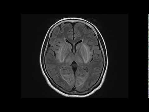 STEC-hemolytic uremic syndrome (HUS) and encephalopathy