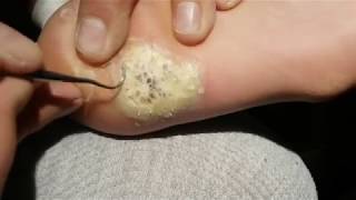 Ugly Wart Removal
